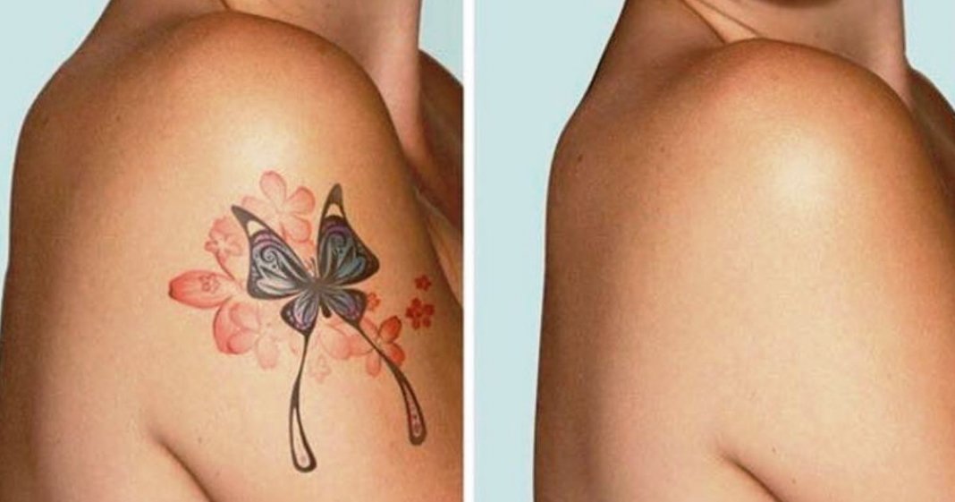 Aprende a “apagar” tatuagens