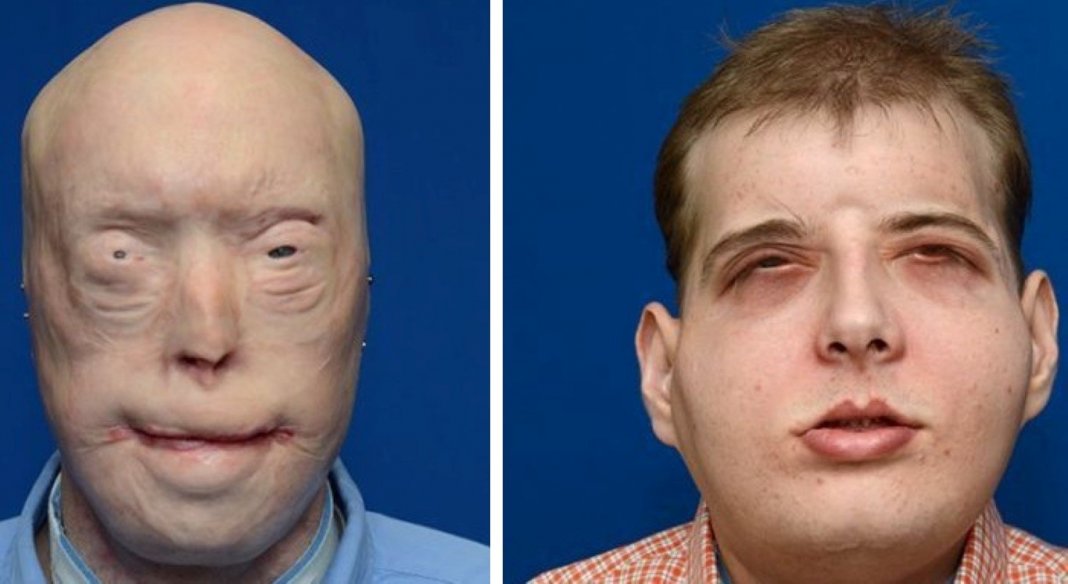 Bombeiro recebe o maior transplante facial que já alguma vez foi feito
