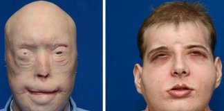 Bombeiro recebe o maior transplante facial que já alguma vez foi feito