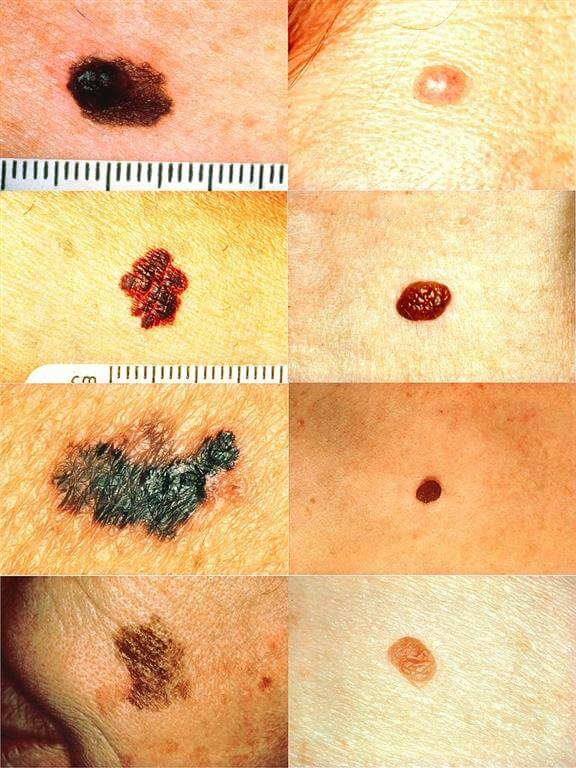 inspiringlife.pt - Cancro da pele: como distinguir uma vulgar verruga de melanoma
