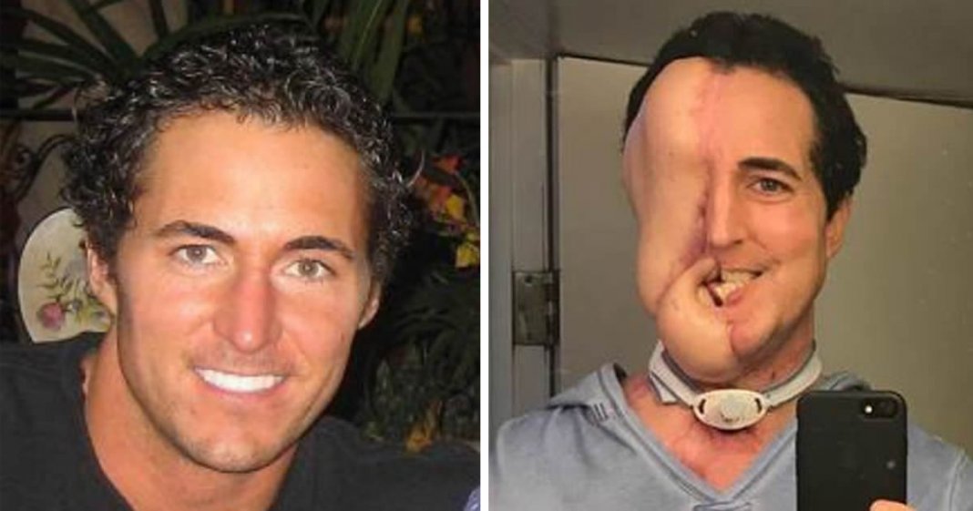 Homem com rosto desfigurado devido a cancro consegue reconstrução