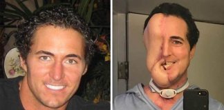 Homem com rosto desfigurado devido a cancro consegue reconstrução