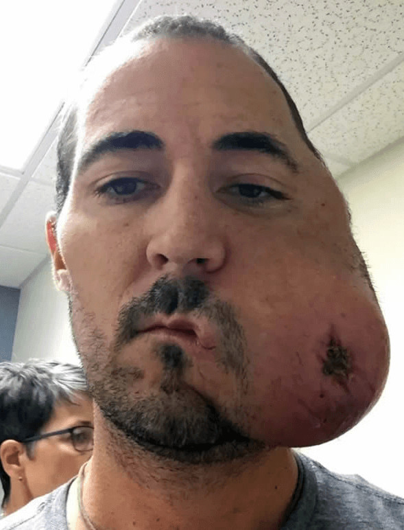 inspiringlife.pt - Homem com rosto desfigurado devido a cancro consegue reconstrução