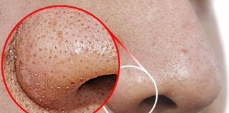 Como removeres pontos negros do teu nariz