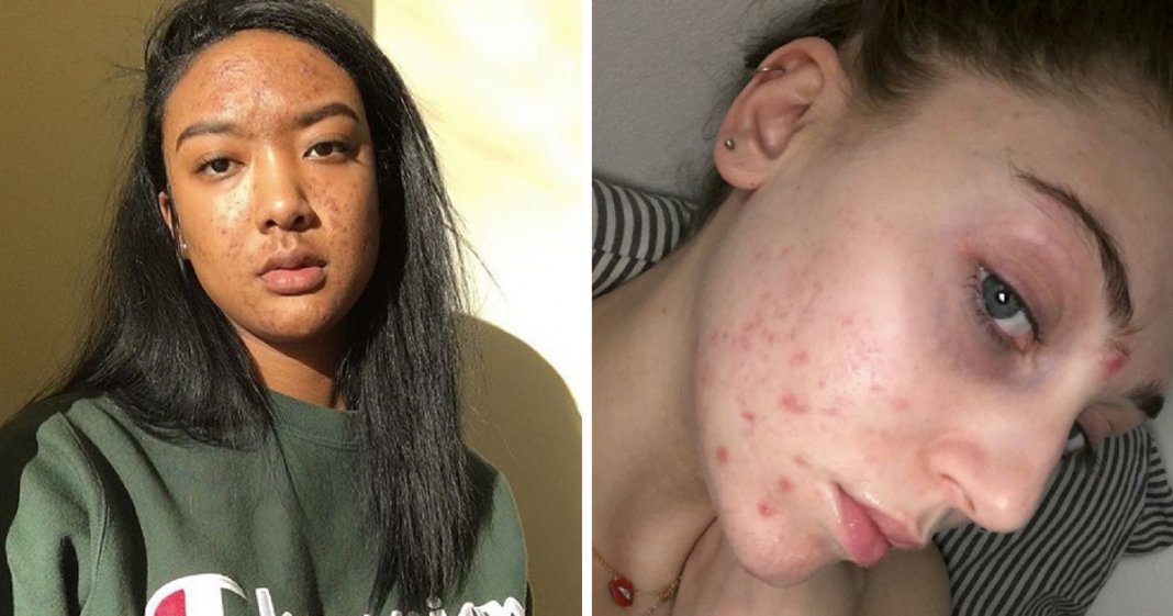 Modelo inicia campanha viral para inspirar as mulheres a aceitarem o seu acne