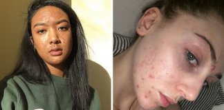 Modelo inicia campanha viral para inspirar as mulheres a aceitarem o seu acne