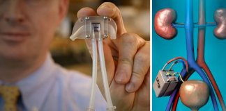 Rim biônico irá substituir máquina de hemodiálise para doentes renais
