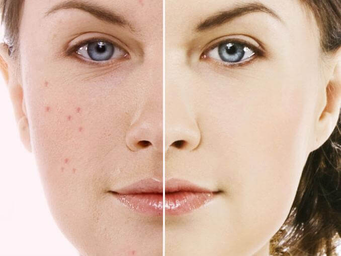 inspiringlife.pt - Estudo revela que acne na adolescência ajuda a ter uma pele mais jovem na idade adulta