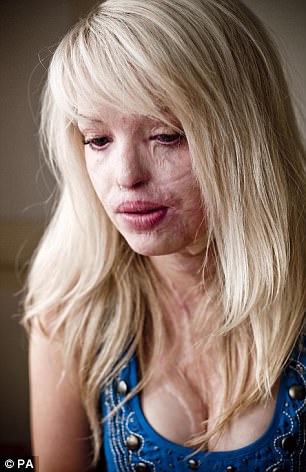 inspiringlife.pt - Mulher passa por 250 cirurgias para recuperar de brutal ataque do seu ex-namorado