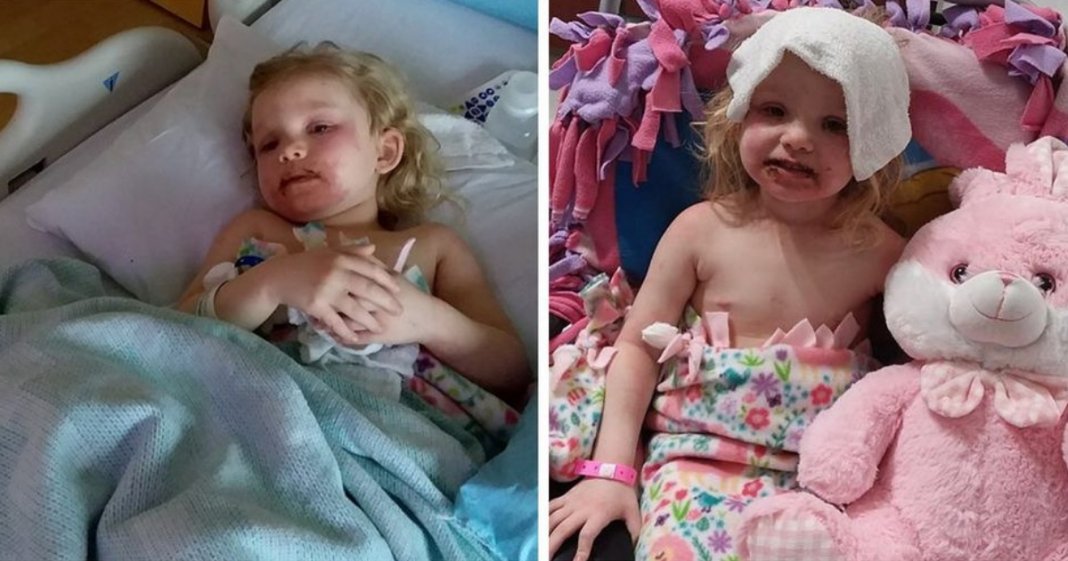 Menina de 3 anos acaba com ferimentos graves graças a um brinquedo “inofensivo”