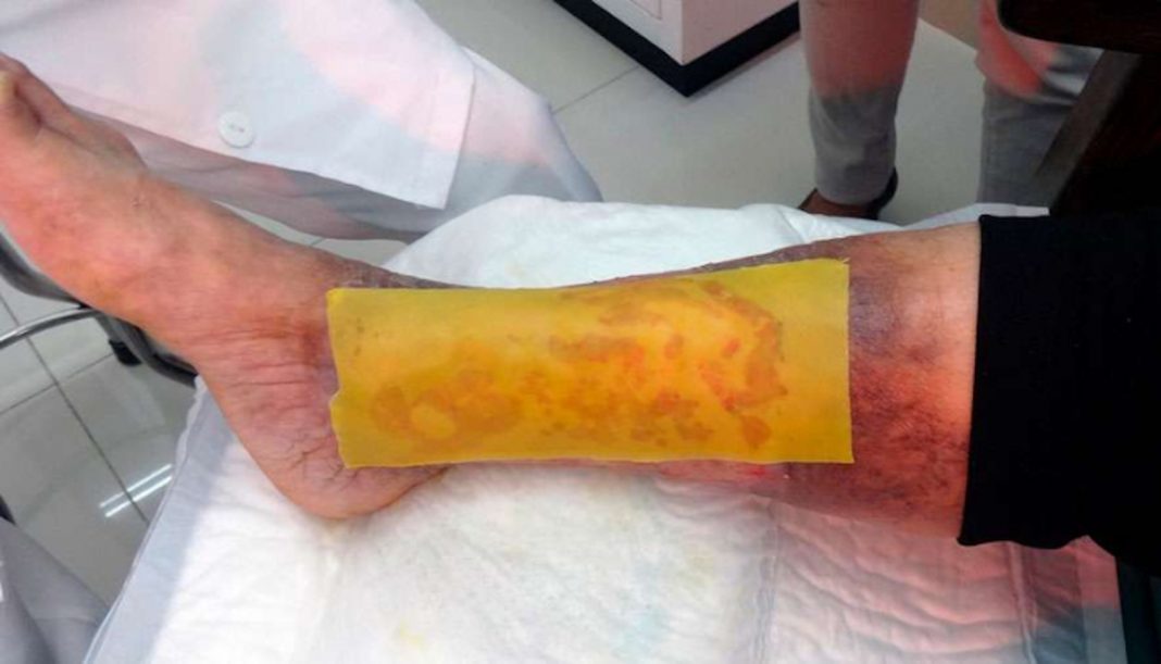 Cientistas criam um adesivo de mel gratuito capaz de curar pé diabético